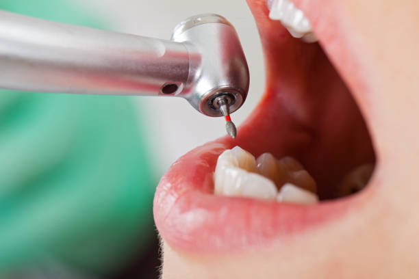 Best Emergency Tooth Extraction in Portola Valley, CA